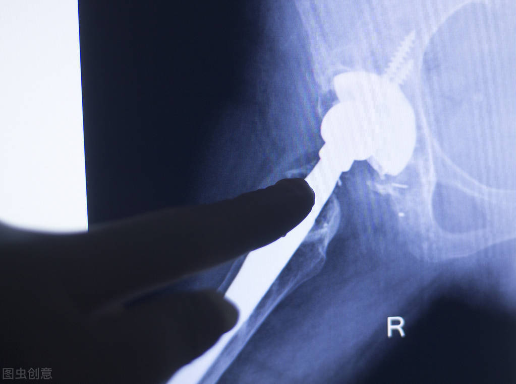 类风湿性手指肿如何消肿,类风湿手指肿了外敷药