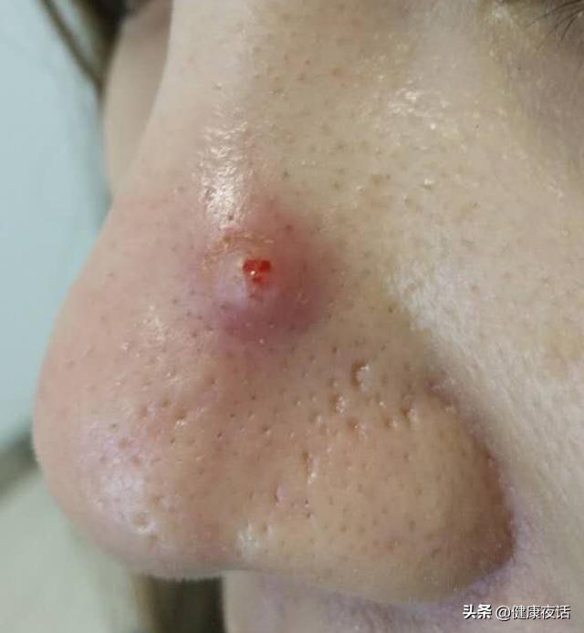 拔鼻毛对鼻腔的危害,有挖鼻屎的习惯是怎么回事