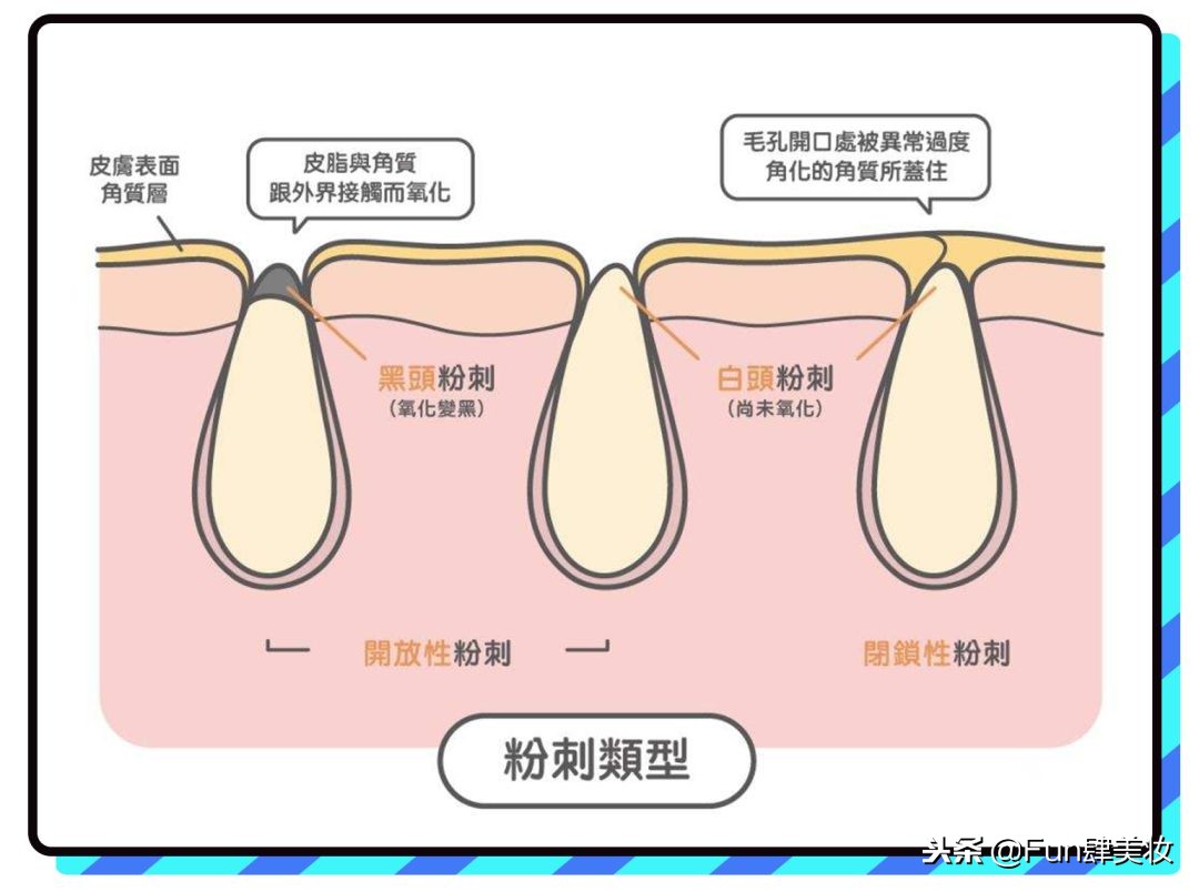 长痘怎么才能不留痘坑,痘肌自救方法视频