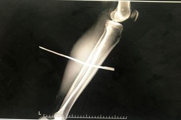 意外致人受伤解决办法,被刀刺伤应该怎么处理
