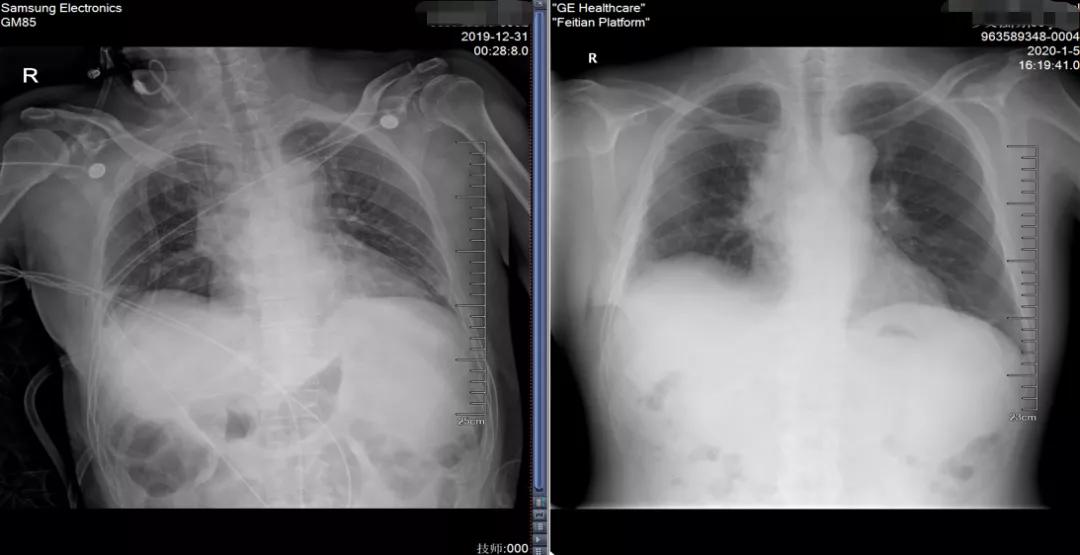 肺癌晚期可以靶向加免疫治疗吗,肺癌晚期化疗加免疫治疗有效吗