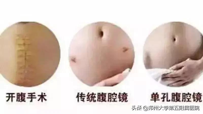 妇产科完成一例经脐单孔腹腔镜下巨大盆腔包块切除术