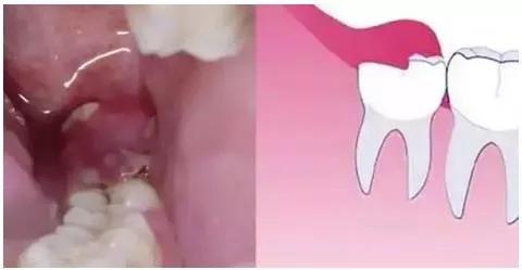 日常的牙病如何护理,疫情期间牙齿怎么修复