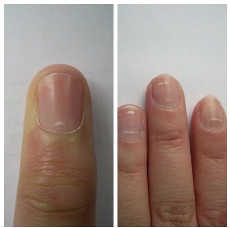 指甲问题对应身体哪里有问题,指甲的各种病变及解决办法