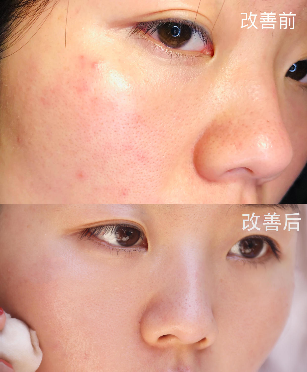 解决毛孔粗大的方法你学会了吗,教大家几招改善毛孔粗大的小技巧