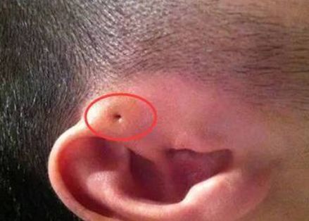 孩子耳朵边长了个疙瘩怎么切除,小朋友耳朵有畸形多大可以动手术