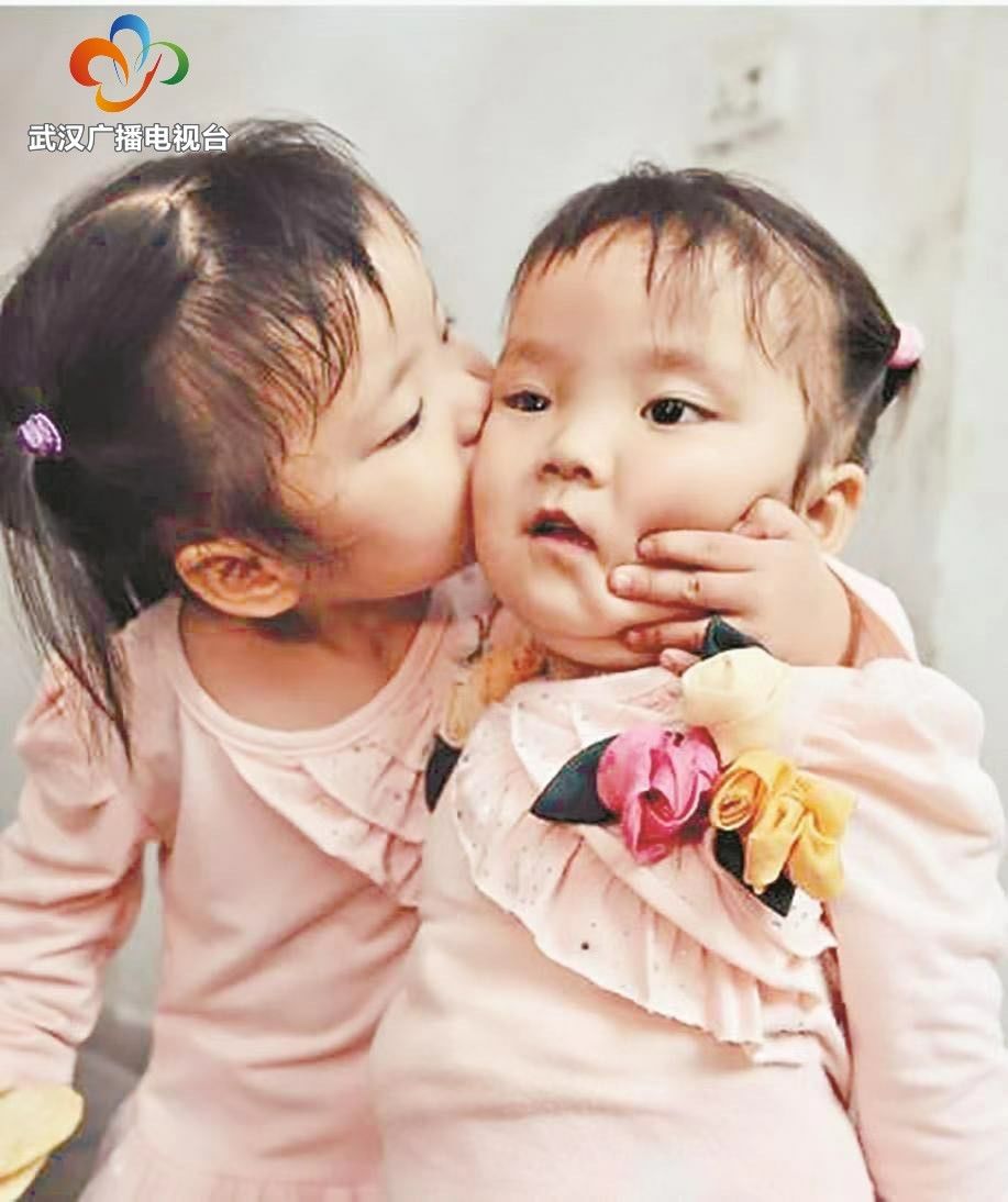 10年前的今天，这对罕见的连体女婴成功“分身”，如今她们牵手上学超暖心