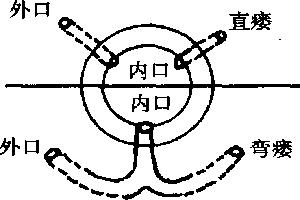 肛瘘要怎么检查才能确诊是肛瘘,什么是肛瘘肛瘘为何必须手术治疗