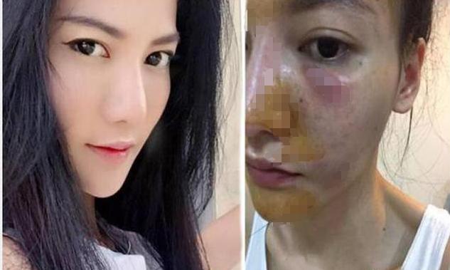 女人打美白针会变白吗,长期打美白针对身体有危害吗