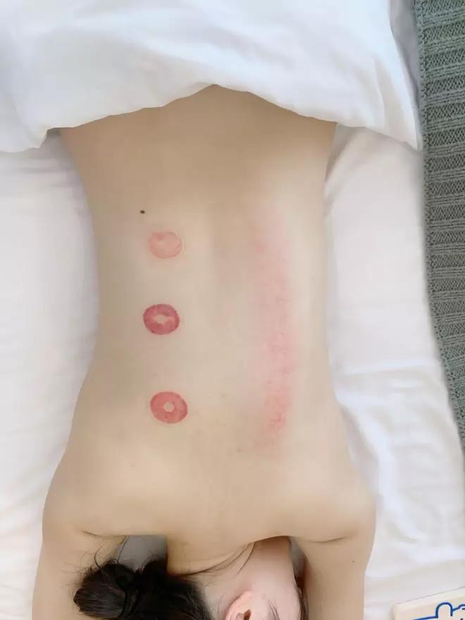 砭石刮痧拔罐按摩,刮痧拔罐中医养生