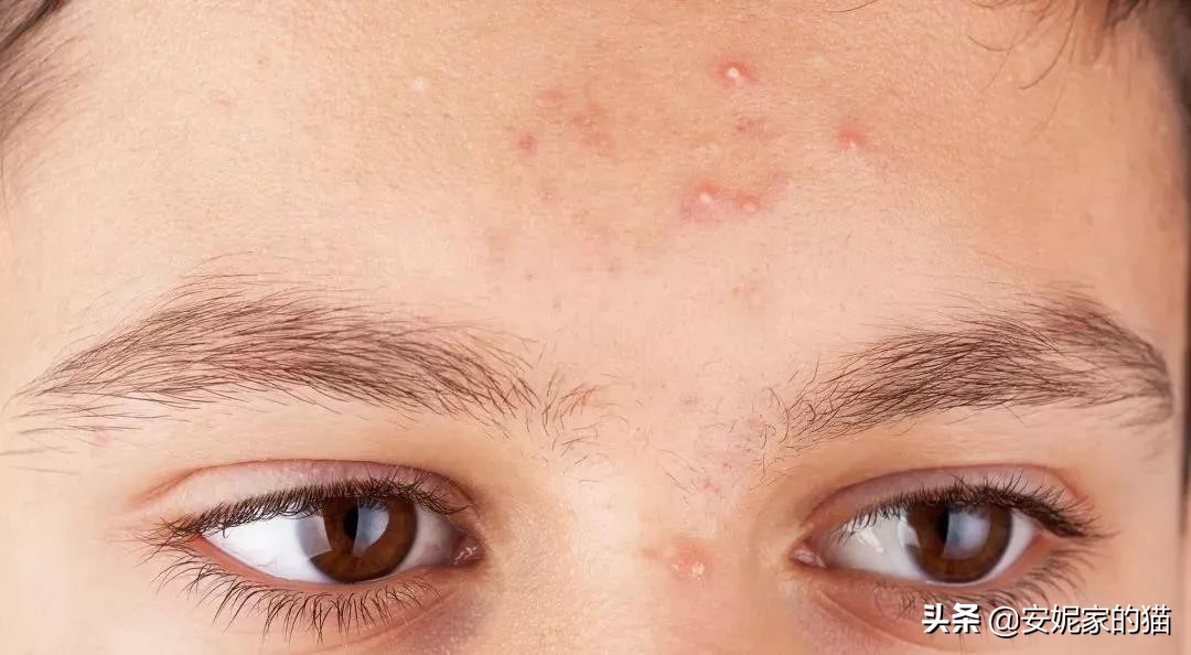 一招教你高效祛闭口,长闭口的正确消除小技巧