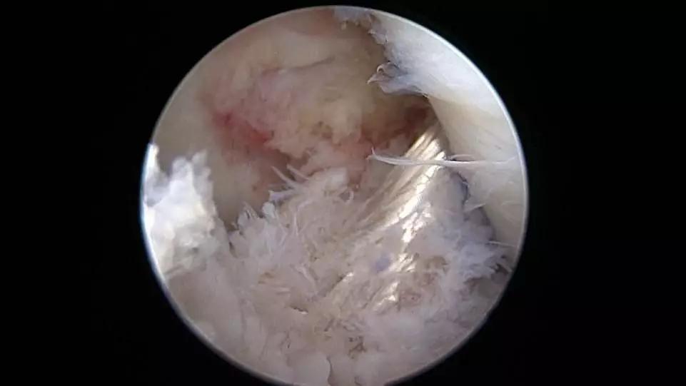 滑雪运动前叉韧带损伤康复,滑雪导致前交叉韧带断裂