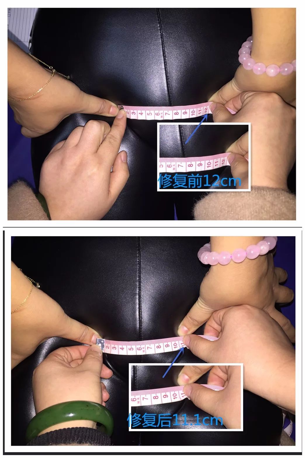 产后骨盆修复恢复多少厘米,产后盘腿坐对骨盆恢复有影响吗