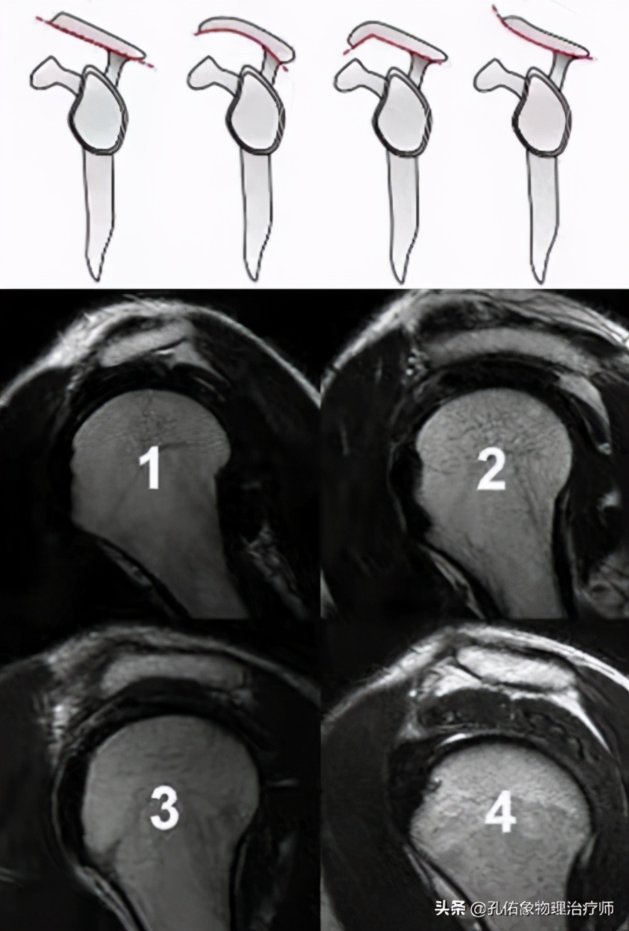 老年人肩周疼痛的厉害怎么治疗,老年人肩背部疼痛怎么回事