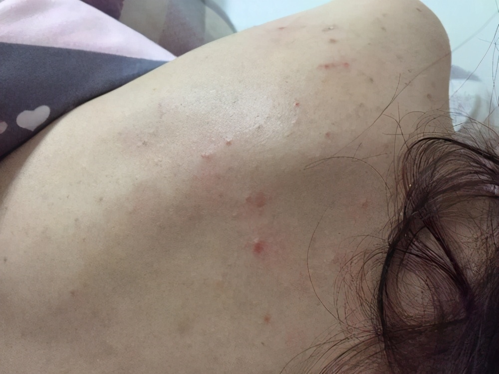 敏感型痘痘是怎么形成的,敏感性肌肤痘痘皮肤用什么面膜