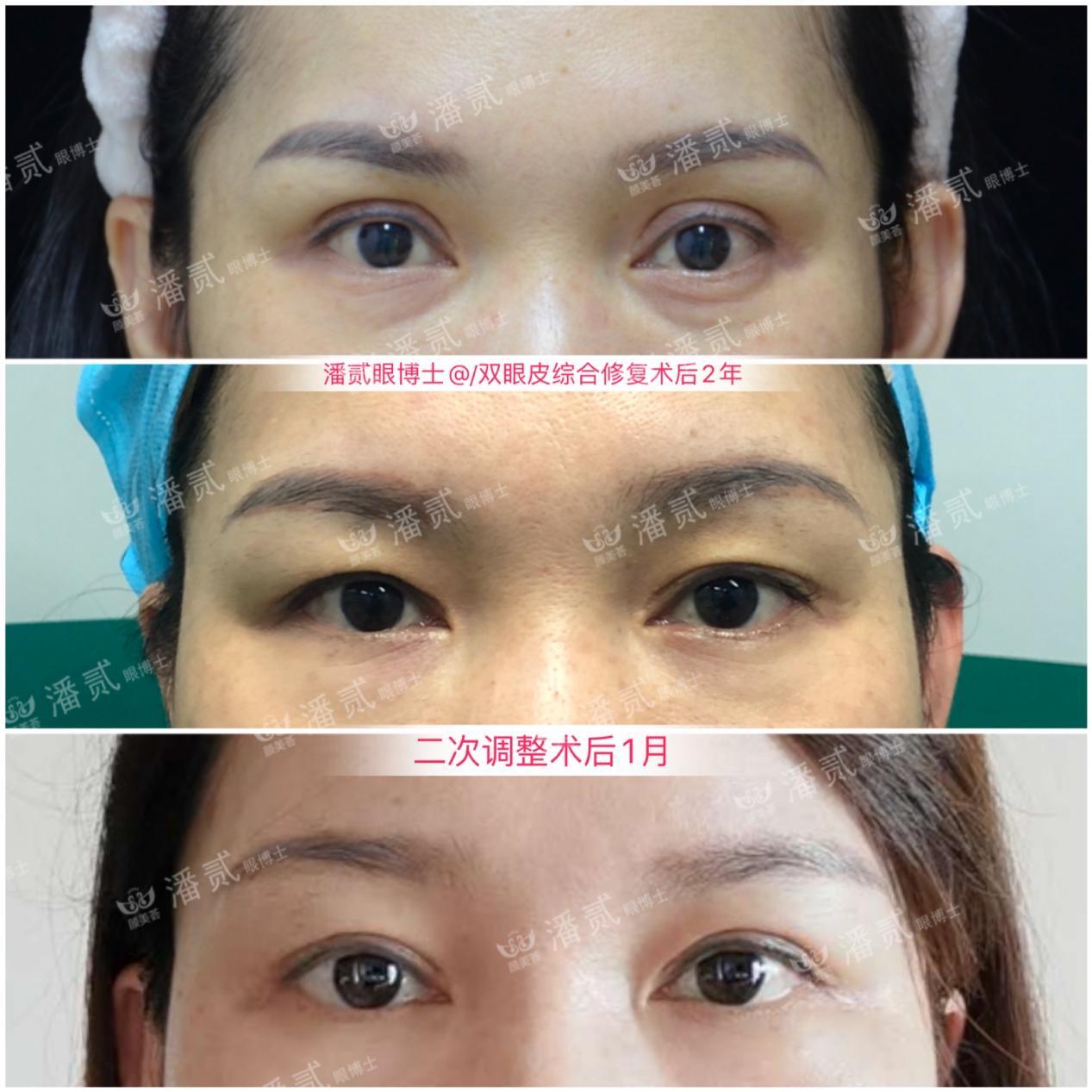 双眼皮太深显老怎么修复,双眼皮失败后修窄