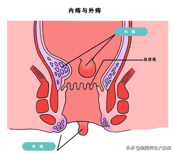 血栓性外痔是几级疼痛,血栓外痔疼痛一般多久