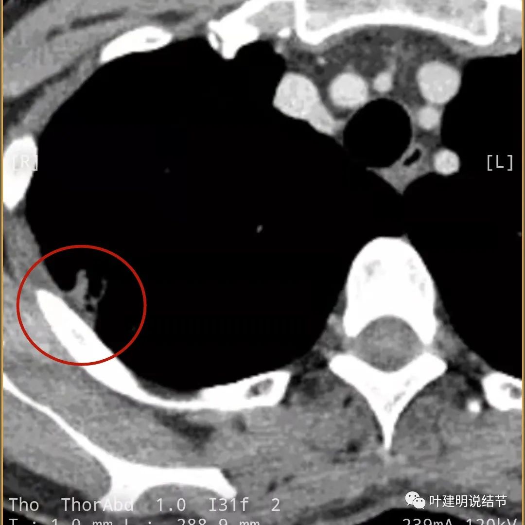 临床诊断孤立性肺结节,空洞型结节一般是什么性质