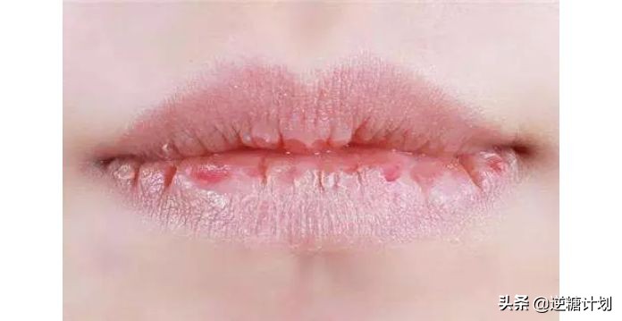 嘴唇口角干裂脱皮唇炎怎么办,成年人口角炎干裂最快治疗方法