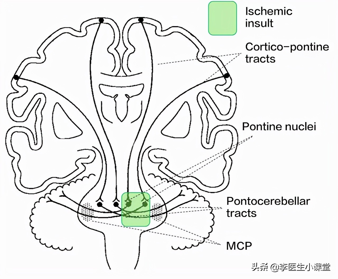老年人补充叶酸预防脑梗有讲究,老人吃叶酸防脑梗有讲究