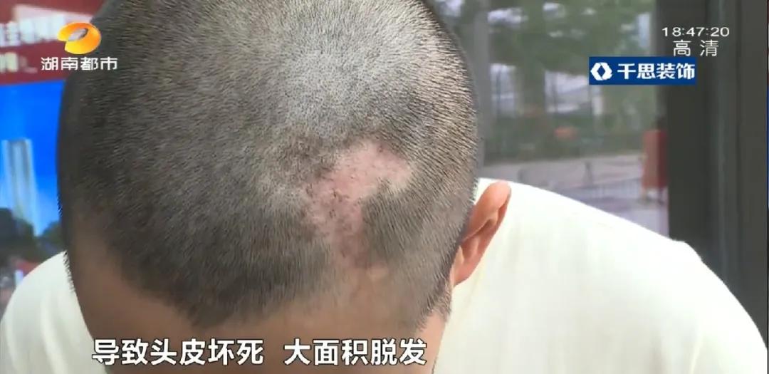 长沙29岁小伙接受5项整形，术后头皮坏死致大面积脱发！《民法典》侵权责任编：须告知医疗风险并征得同意