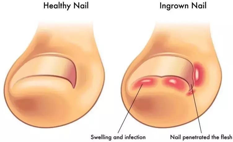 脚趾甲往肉里长怎么办很疼,脚趾甲长灰趾甲是什么情况