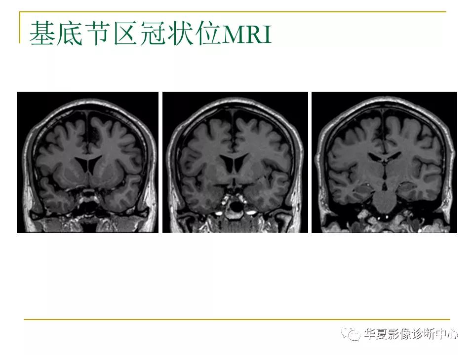 中国人脑立体定向mri应用解剖图谱,脑mri示意图