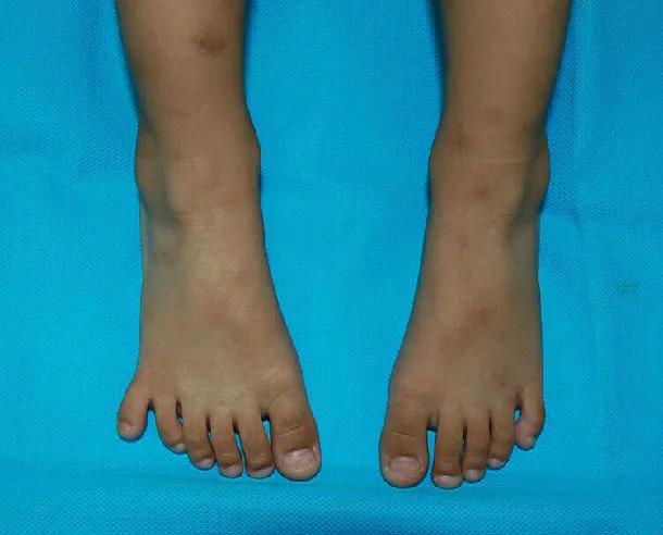 孩子腿弯处疼痛是什么原因,怎么判断孩子腿弯不弯