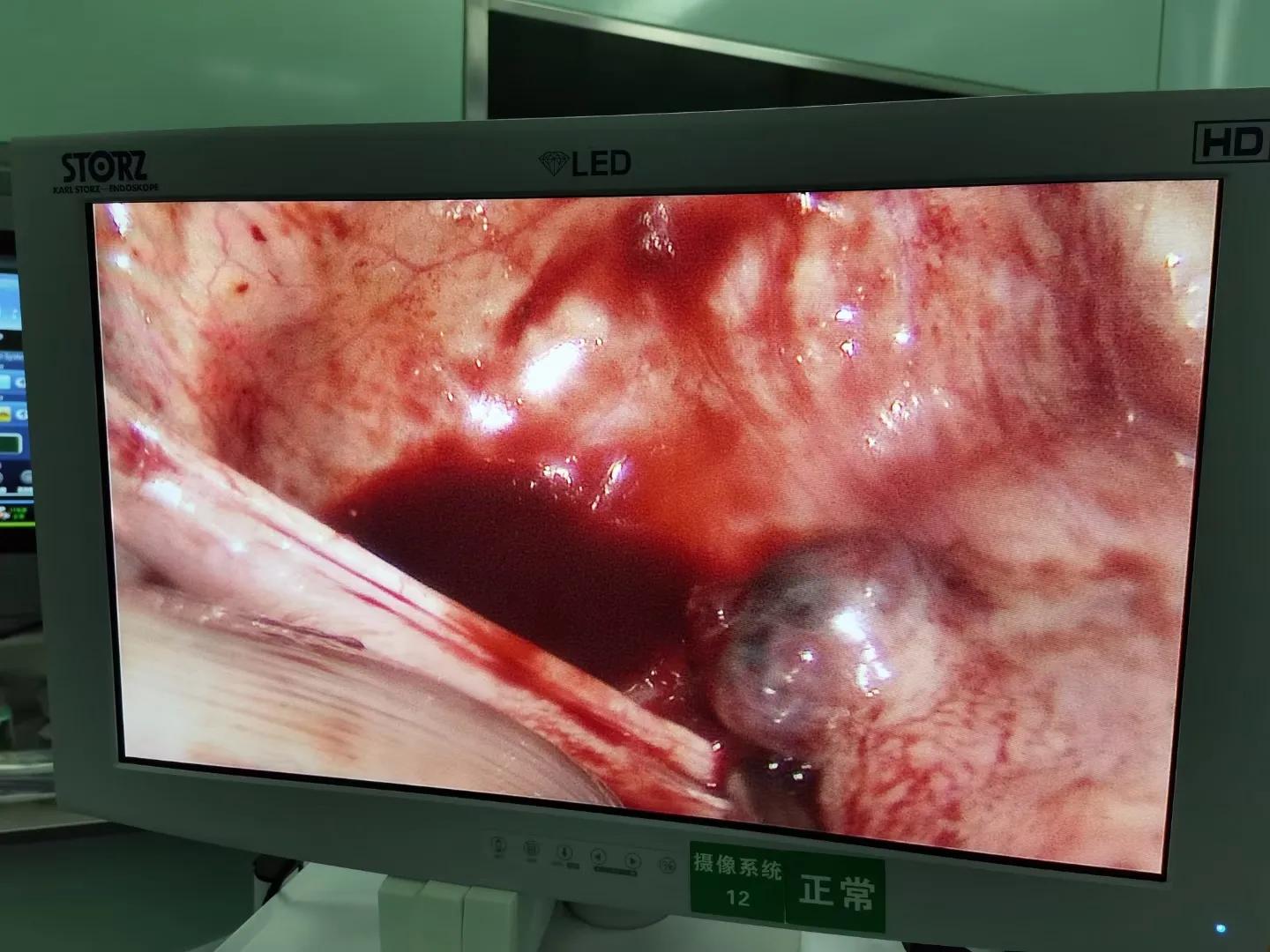 人流后5天腹痛剧烈,无痛人流术后四天腹痛