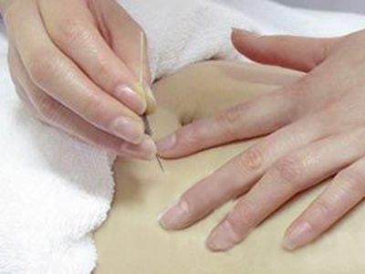 针刺调气的基本原则,针刺时出针难什么原因