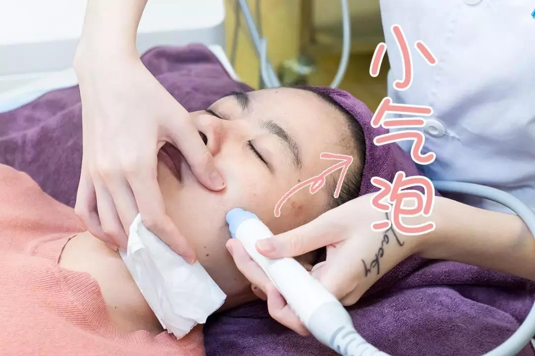 福州如何有效祛痘坑,福州快速祛痘