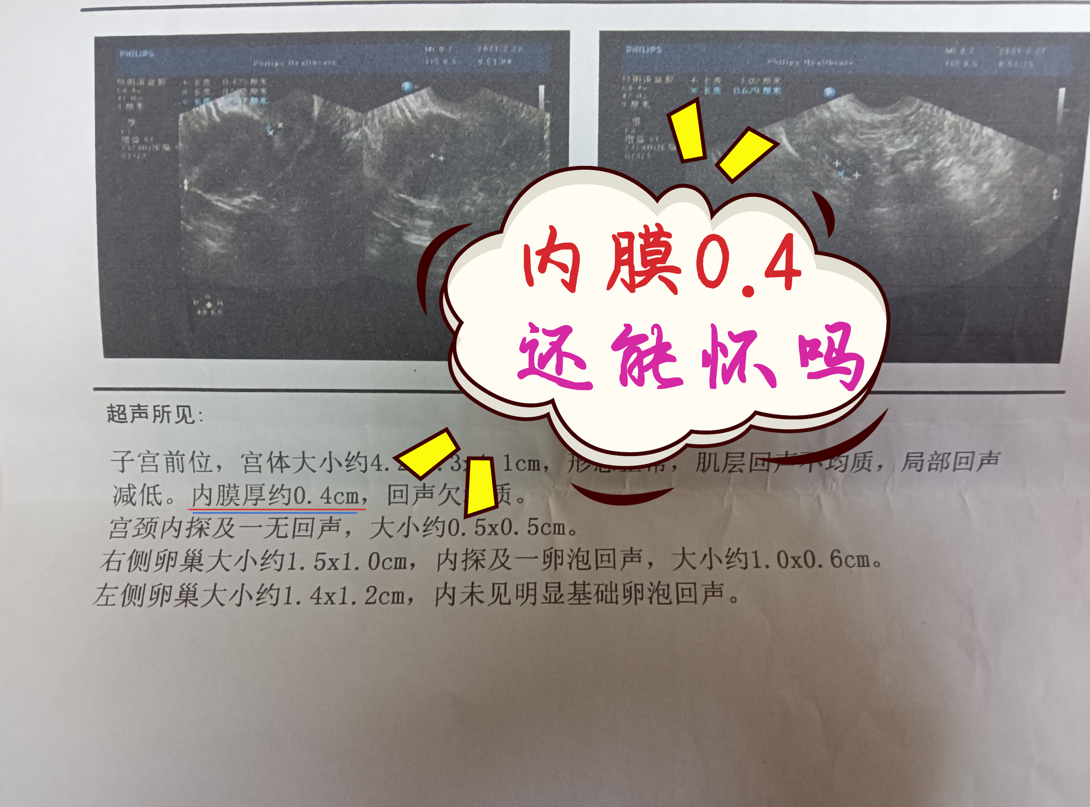 人流后内膜薄吃什么食物,人流引起的子宫内膜薄吃什么中药