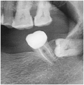 你们做根管治疗花了多少钱,根管治疗做了真的有用吗