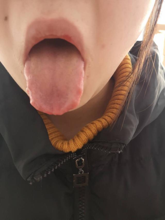 中药治疗腮腺炎、低热患者病案1例（1周）