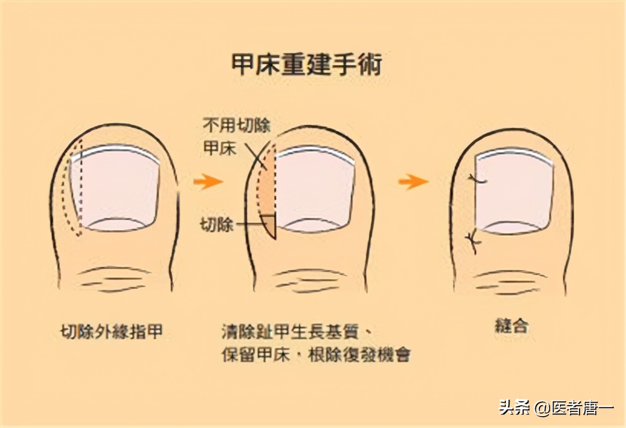 甲沟炎是不是治不好呀,甲沟炎对脚趾的伤害