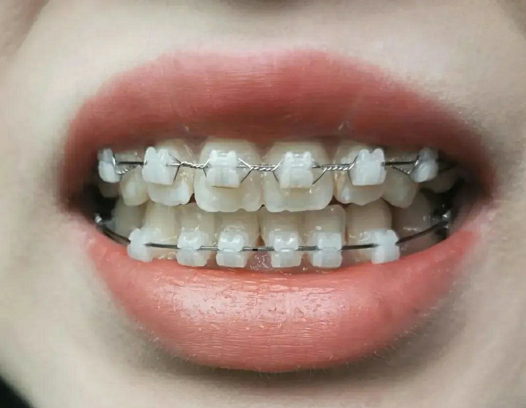 杭州做矫正牙齿价格多少,在杭州做牙齿修复多少钱