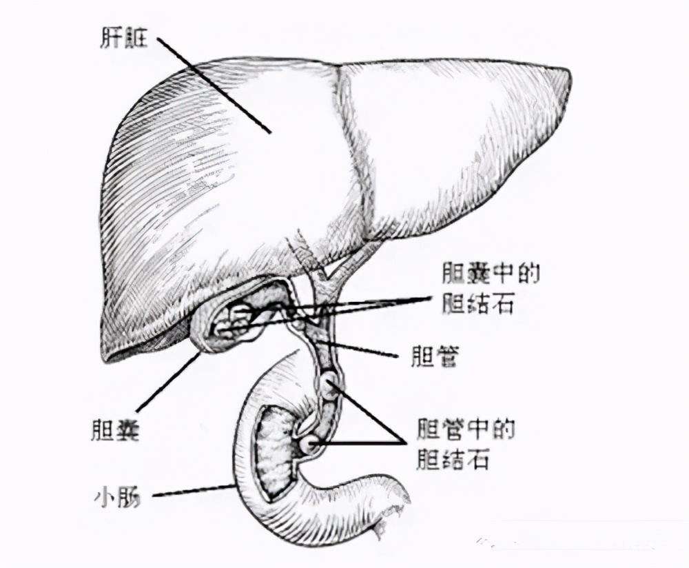 有胆结石要不要割,有胆结石要把胆囊全部切除吗