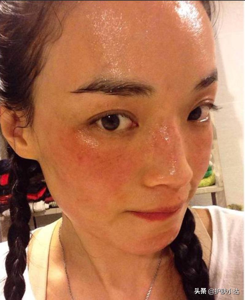 顽固血渍洗不掉怎么办,红血丝的克星一招根除