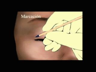 割双眼皮后怎样可以尽快完全恢复,割的双眼皮很不自然要怎么修复呢