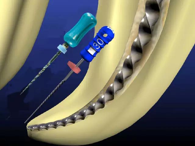 抽牙神经3d动画,抽牙神经痛吗