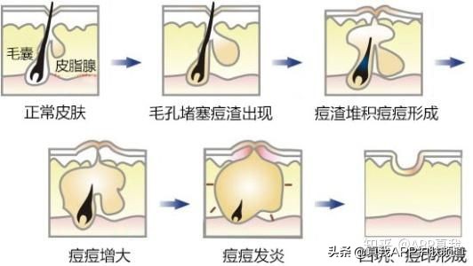 去痘印产品终极盘点，这几款效果肉眼可见！网友：价格效果成正比