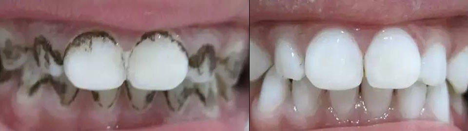 6岁孩子牙齿发黑腐蚀怎么处理,孩子的牙齿全部发黑怎么办