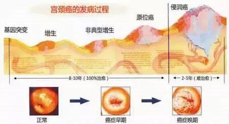 癌前病变就是一定会得癌吗,癌前疾病和癌前病变区别
