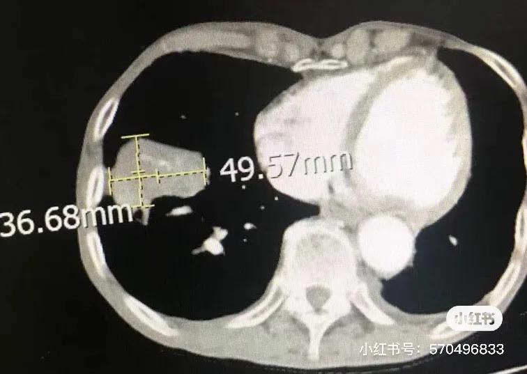 冷冻针治肿瘤能活多久,一根细针可以消除肿瘤