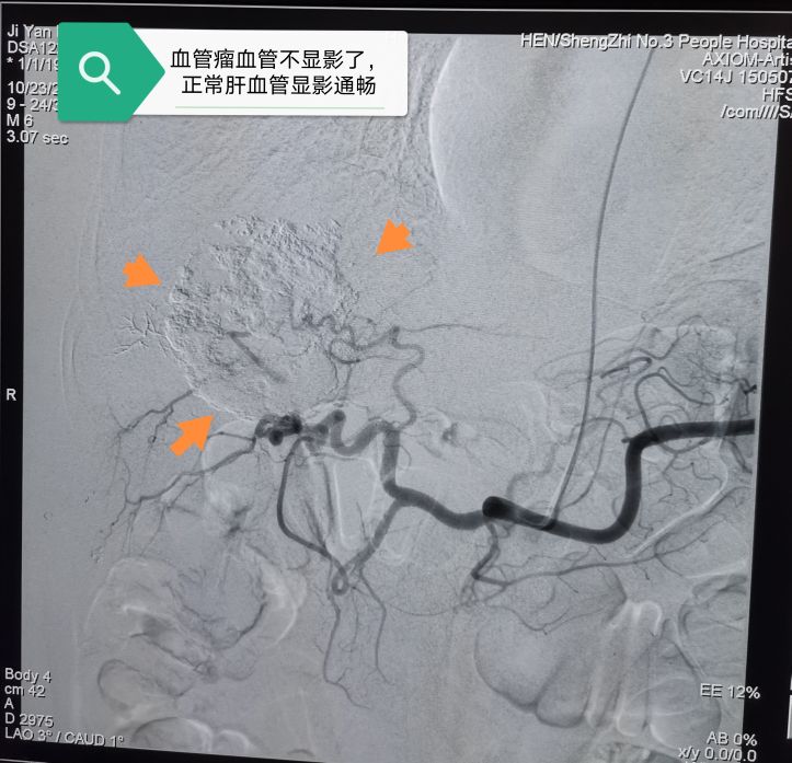 肝血管瘤10公分了介入治疗可以吗,介入治疗肝血管瘤是最好的方案吗