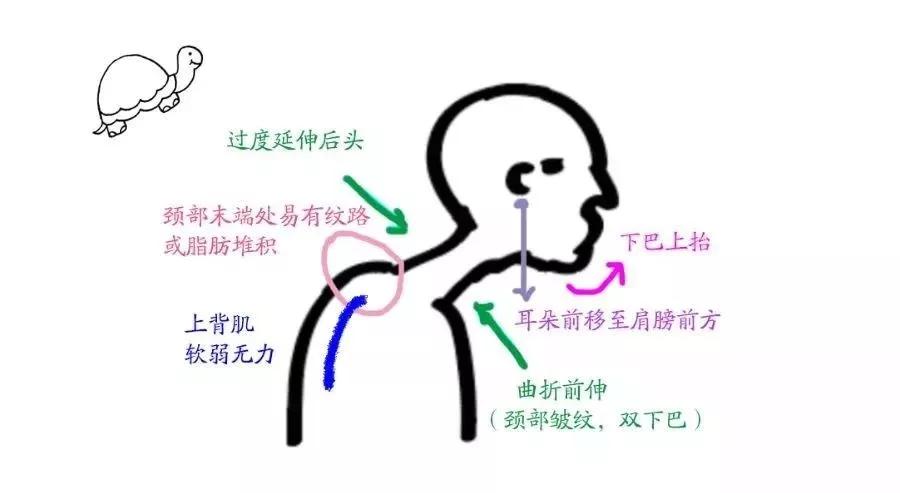乌龟脖可以改善吗,如何矫正乌龟脖