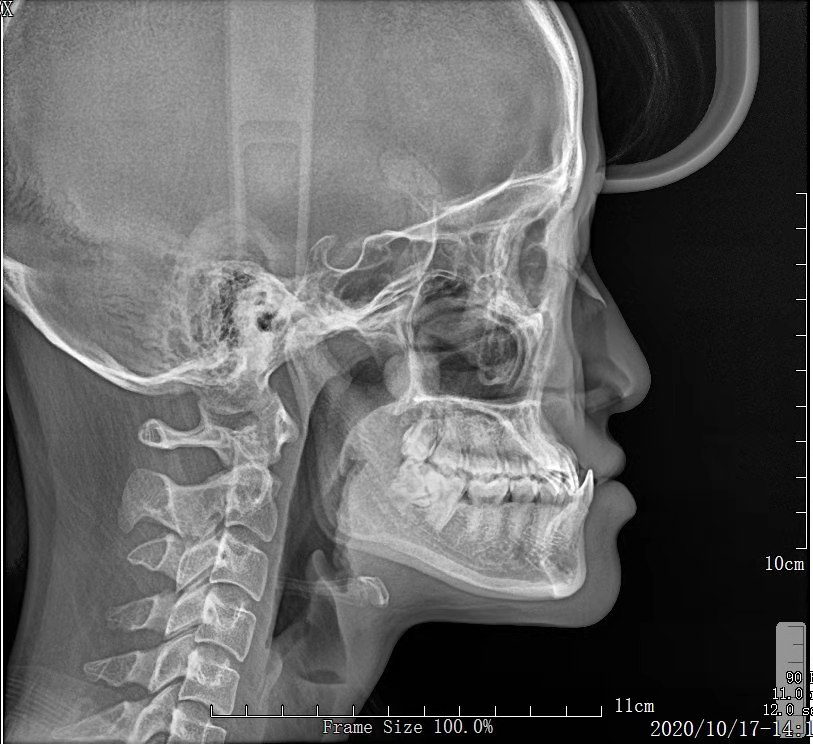 看牙矫正一般去哪里看,矫正牙齿的全套流程