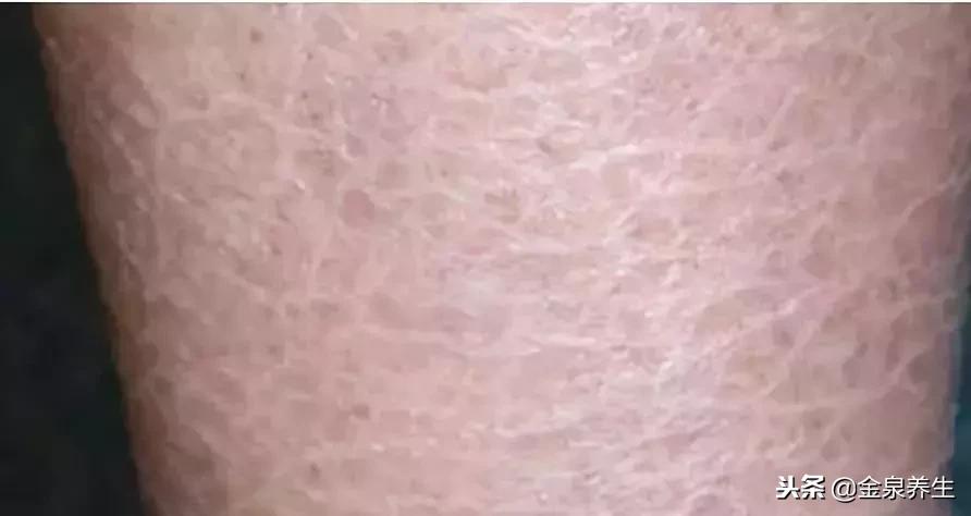 脚后跟干裂起硬皮鱼鳞病,脚后跟像鱼鳞一样一层层干裂中医