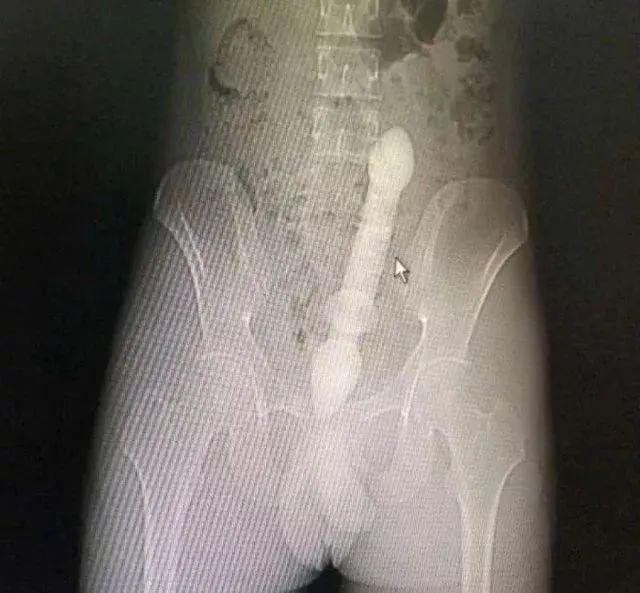 一条罗非鱼“游”进肛门？医生：直肠不直，进去容易出来难