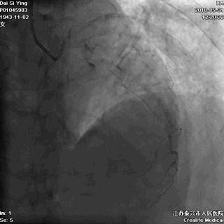 发生心肌梗死怎样急救,发生心肌梗死的护理和措施